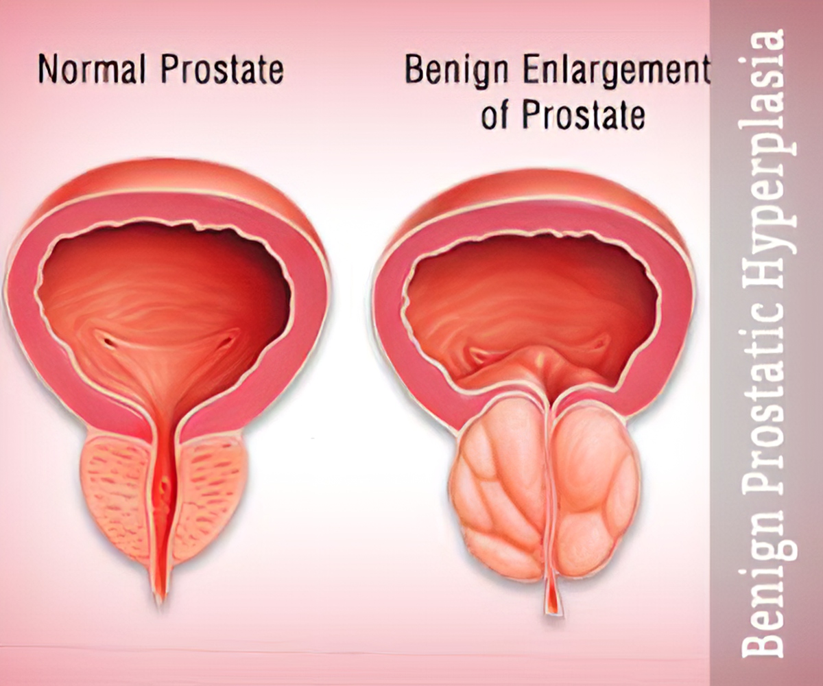 Benign prostatic hypertrophy (BPH)