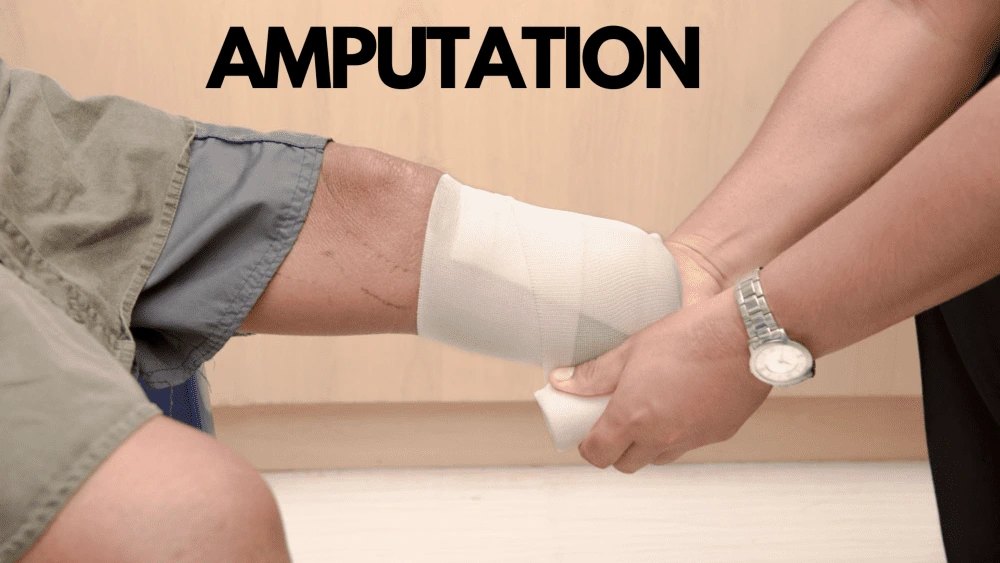 Amputation